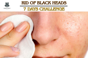 Black Heads
